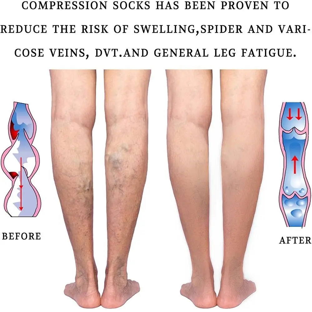 Nuevo Calcetines de compresión de pantorrilla de 20-30mmHg, calcetines transpirables con punta abierta a presión para pantorrilla, calcetines elásticos de presión de 2 niveles para hombres y mujeres - imagen 2